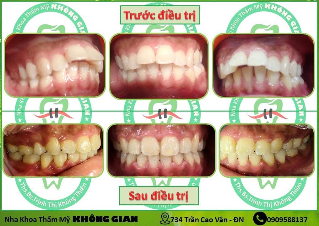 💥 Niềng răng: Khi nụ cười xinh đẹp là chưa đủ....💥