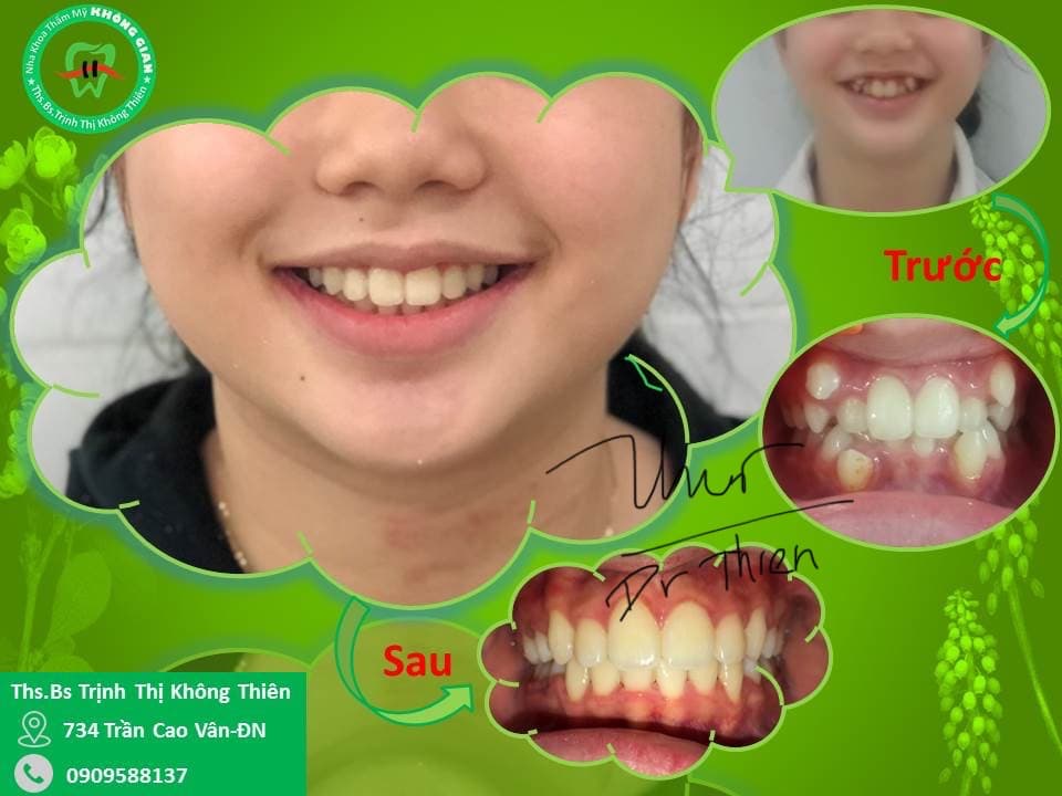 🍀 Răng KHỂNH: nét đẹp và những vấn đề liên quan 🤩