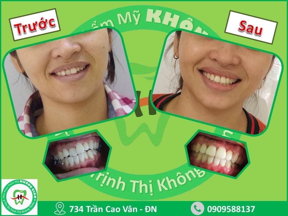 📣📣Răng lệch lạc: lựa chọn niềng răng hay răng sứ thẩm mỹ?🤔🤔🤔